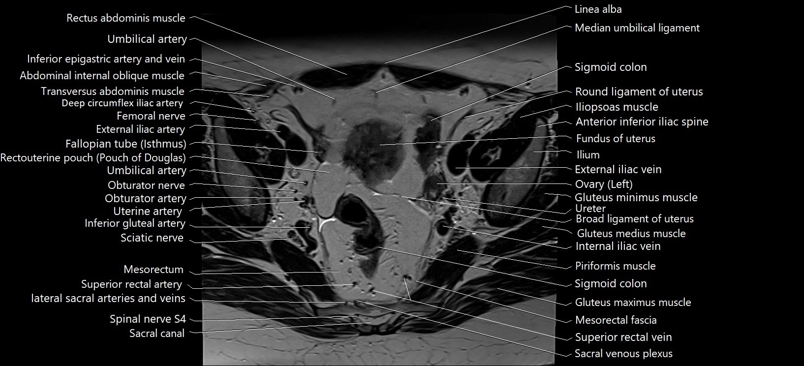 Axial cross sectional anatomy of female pelvis (MRI 3T) image 13.webp